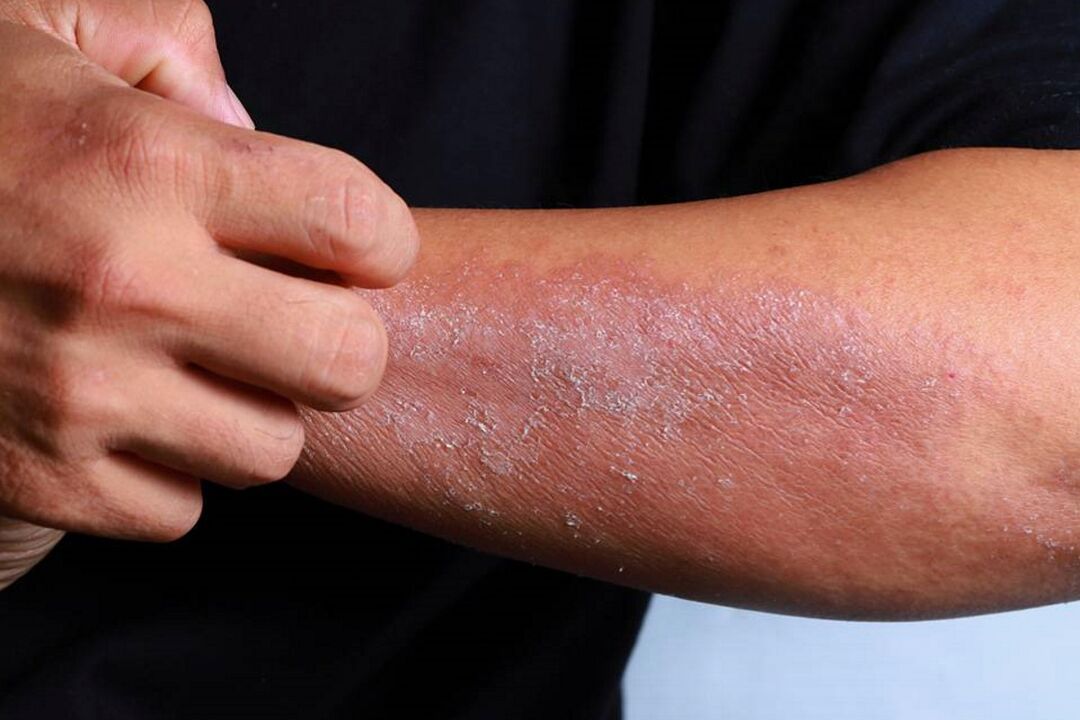 Symptome einer Psoriasis